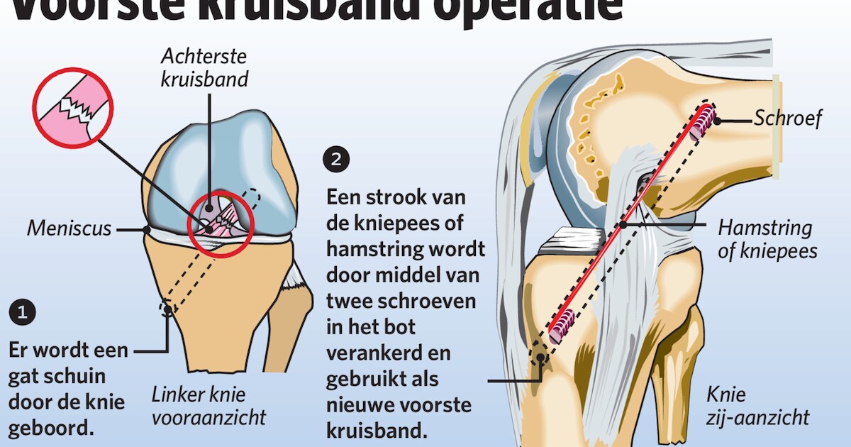 Kruisbandblessure: de hartaanval van de knie | Sport | PZC.nl