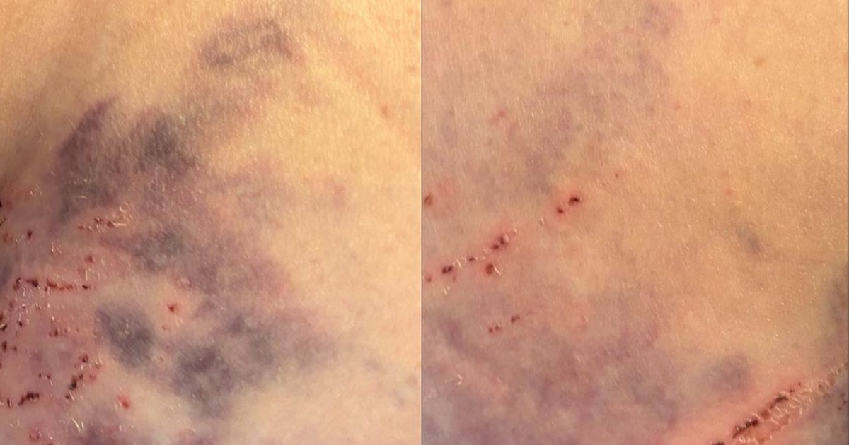 Fietstocht eindigt in drama: Corina hard aangereden door brommer, dader vlucht